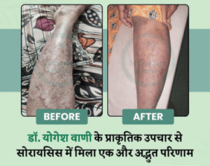 psoriasis treatment Navsari, psoriasis doctor Navsari, psoriasis treatment near Navsari,