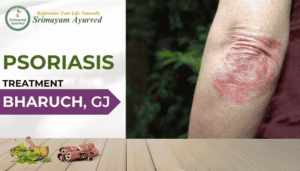 psoriasis treatment in Bharuch, psoriasis treatment near me Bharuch, psoriasis doctor Bharuch