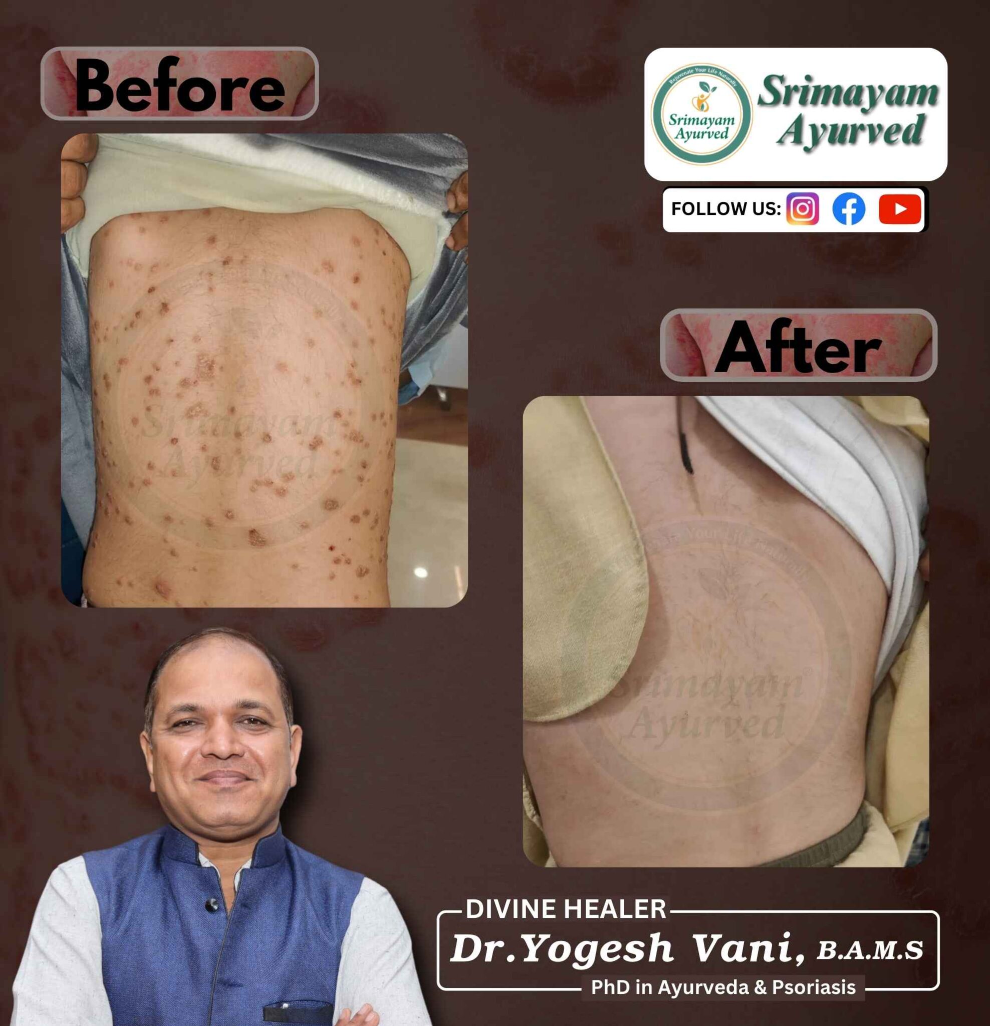 psoriasis treatment in Bharuch, psoriasis treatment near me Bharuch, psoriasis doctor Bharuch