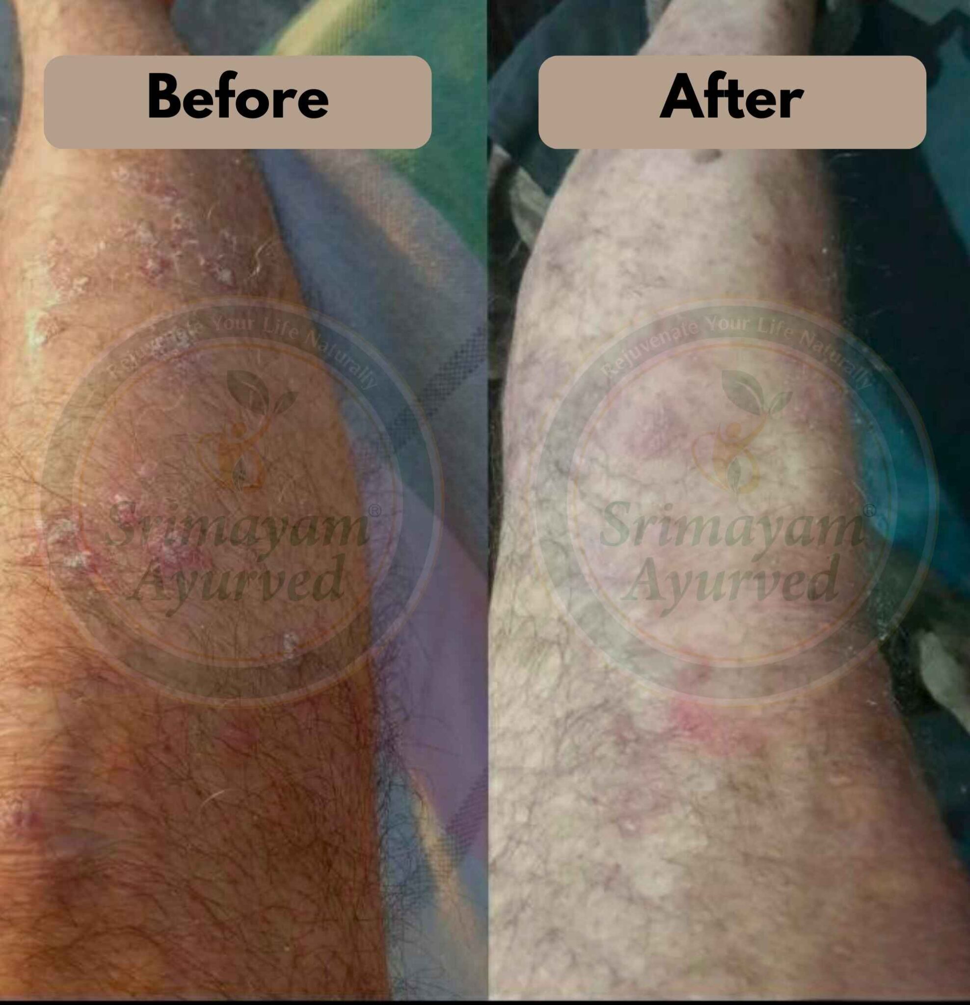 psoriasis treatment in Bharuch, psoriasis treatment near me Bharuch, psoriasis doctor Bharuch