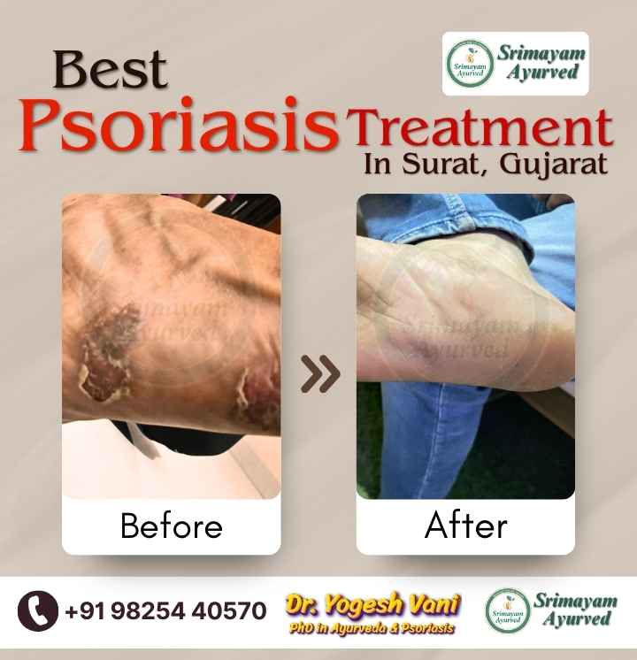 psoriasis treatment in Ankleshwar, psoriasis treatment near me Ankleshwar, psoriasis doctor in Ankleshwar