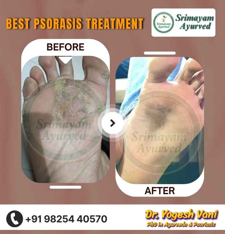 psoriasis treatment in Ankleshwar, psoriasis treatment near me Ankleshwar, psoriasis doctor in Ankleshwar